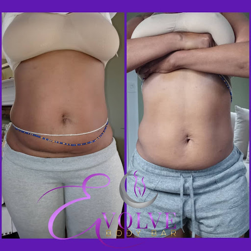 Evolve Body Bar - Visual
