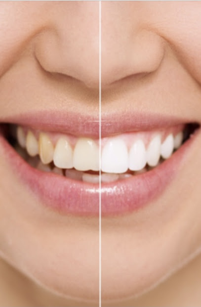 Brighter U Tooth De`Cor & Whitening