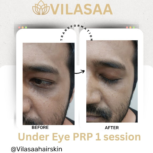 At Vilasaa Hair and Skin Centre in Ghaziabad, PRP (Platelet-Rich Plasma) therapy for under-eye da…