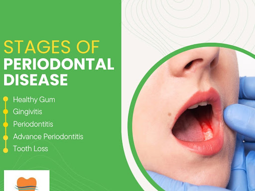 Gingivitis: Gingivitis is the earliest stage of periodontal disease. It is characterized by infla…