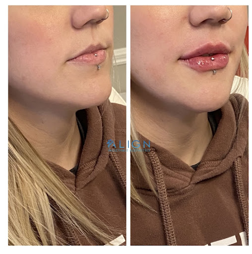 Align Injectable Aesthetics