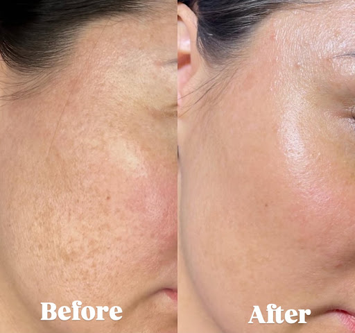 Check out these stunning before & after results from our Brightening