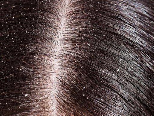 DANDRUFF post image