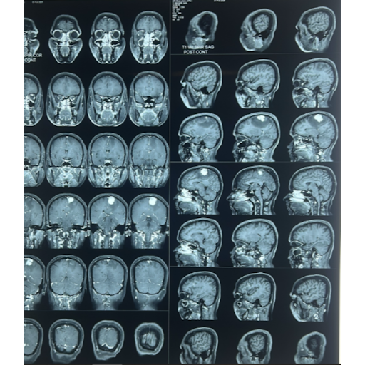 Are neurological problems affecting your health and peace of mind? Dr. Vivek Jadhav in Jalgaon of… post image