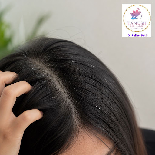Struggling with persistent dandruff even after trying multiple shampoos and home remedies? At Tan… post image