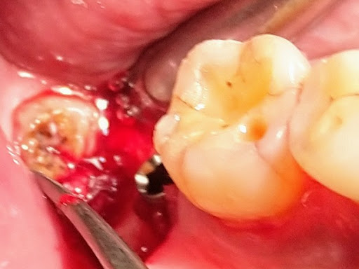 Implant placement surgery