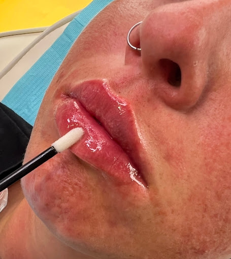 The Ocean Clinic Skegness - Botox - Fillers - Acne - Laser Hair & Tattoo Removal - Thumbnail