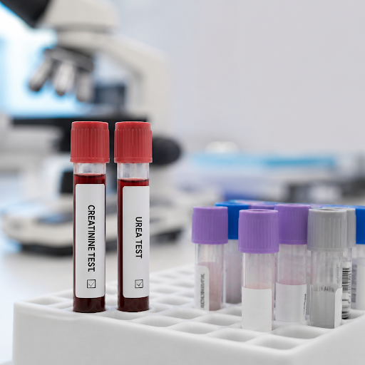 Kidney health often gets ignored until problems become serious. Regular creatinine and urea tests… post image