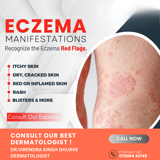 Common red flags of eczema include dry, scaly skin, persistent itching, red or dark patches, smal…