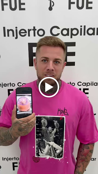 Injerto Capilar FUE Málaga