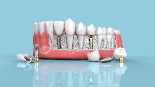 Limited Time Offer on Dental Implants post image