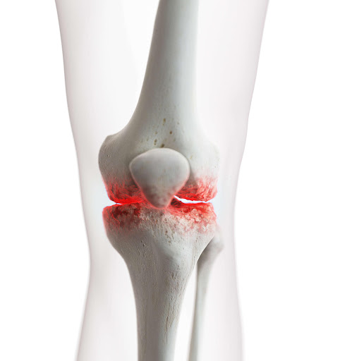 Knee pain that doesn't improve with medicines or physiotherapy could be a sign of severe arthriti… post image