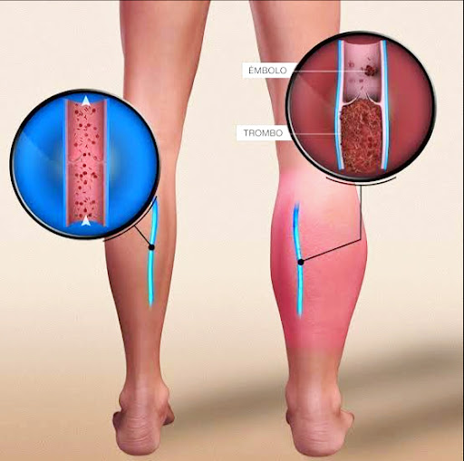 Dr. Bryan Orozco Rangel Angiólogo y Cirujano Vascular - Thumbnail