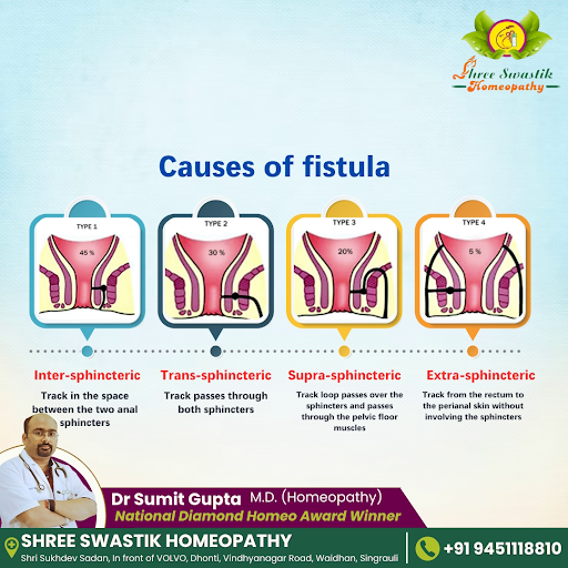 Understanding the causes of fistulas is essential for effective treatment. Here are the different… post image