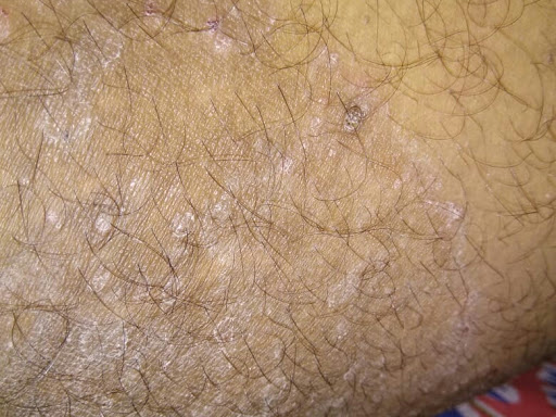 Cured within  1 week (Dr Soumya Dey's Clinic desk) 