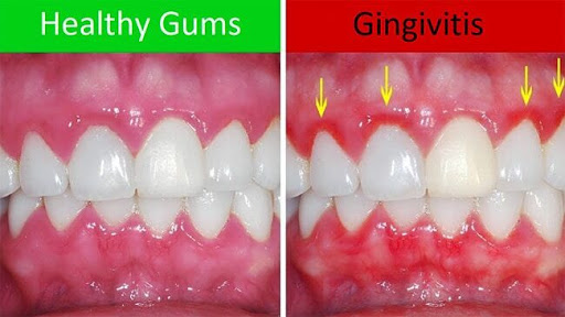 यह Gingivitis हो सकता है — इसे हल्के में न लें! post image
