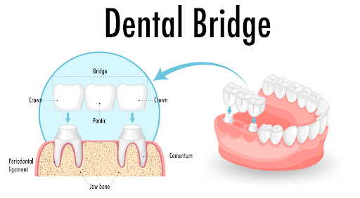 Periodontal Prosthesis is a specialized dental treatment designed to restore function and aesthet… post image