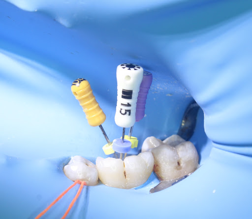 Dr. David Avila - ENDODONCIA