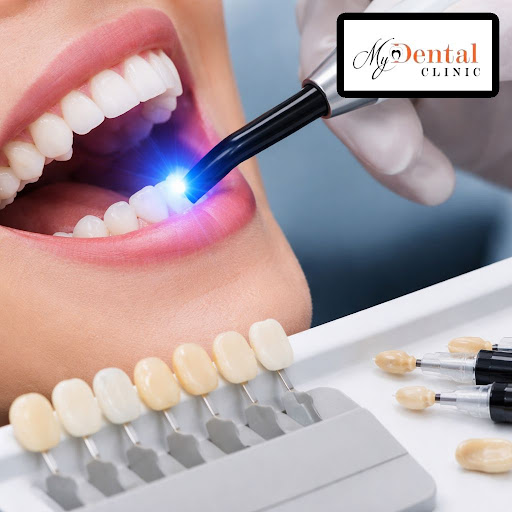 Want to fix cavities without visible silver fillings? At My Dental Clinic - Dr. Neha Chintawar in… post image
