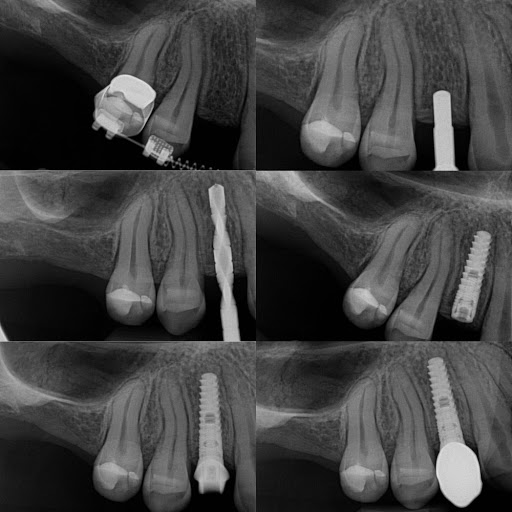 Luxor Dental: Prosthodontics, Dental Implants, and Wisdom Teeth Surgery Gallery - United States