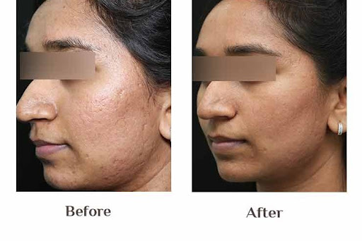 ✨ Acne Scars Don’t Have to Be Permanent post image