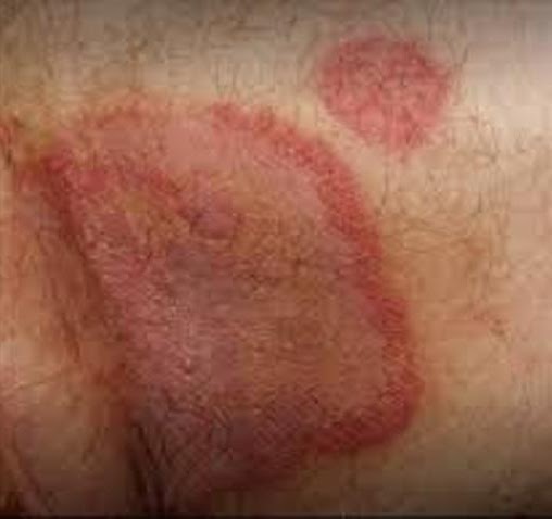 FUNGAL INFECTION ( RING WORM ) post image