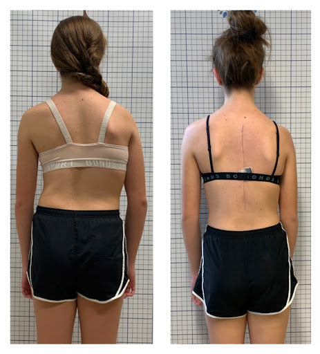 QLD Scoliosis Clinics - Brisbane - Thumbnail