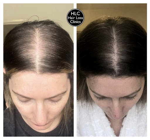 Cardiff Hair Loss Clinic - Thumbnail