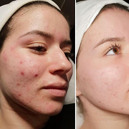 Photo n°8 de Microneedling à domicile à Vincennes (Esthéticien)