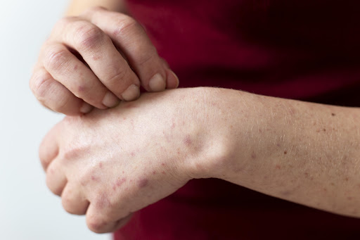 Atopic dermatitis is a common chronic skin condition characterized by dry, itchy, and inflamed sk…