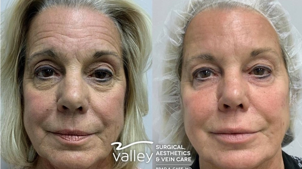 Valley Surgical Aesthetics Vein Care Dr Brad Case