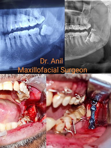 A Case of Jaw fracture operated and restored his chewing Function - Facial Trauma Surgeon @ Manid… post image