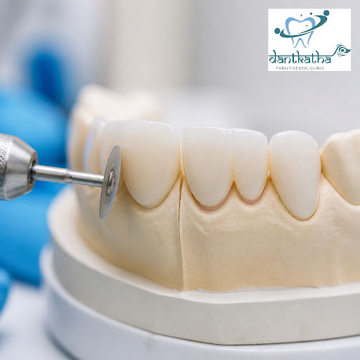 Thinking about subtle changes to your smile without major treatment? Teeth reshaping (contouring)… post image