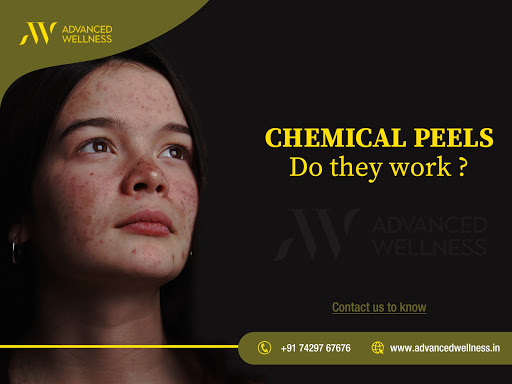 A chemical peel is a skin treatment that can reduce acne, scarring, wrinkles, and sun damage to g…