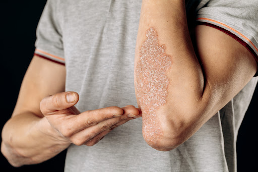 Early diagnosis and appropriate Psoriasis Treatment are important for managing symptoms and impro… post image
