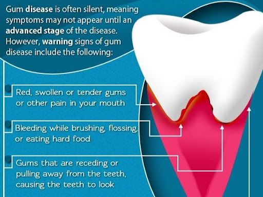 Know about Gum diseases symptoms. post image