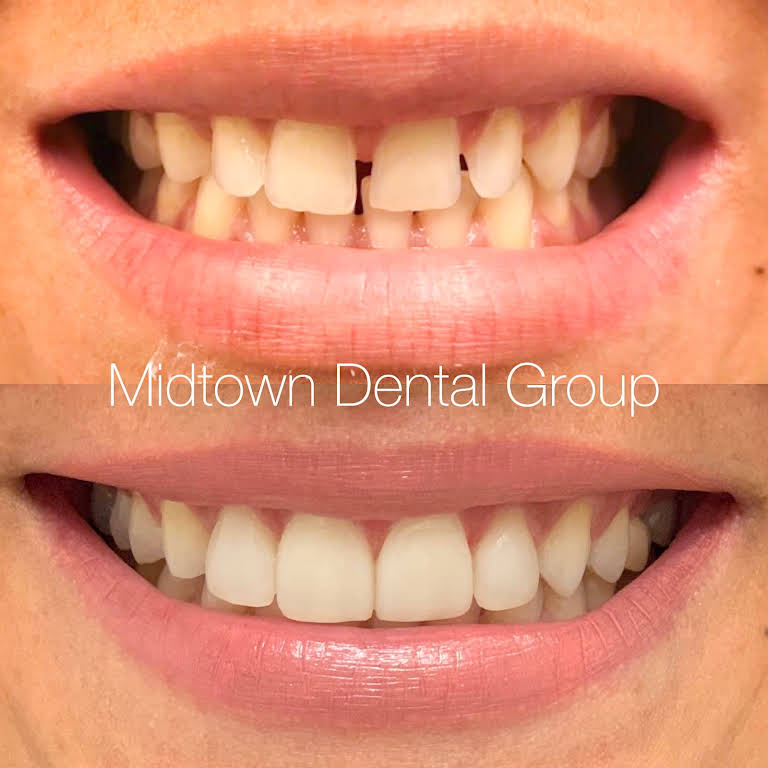How Do You Keep Your Teeth Straight After Orthodontics? - Midtown Dental  Group