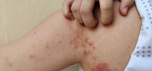 Skin Allergy Specialist in Jaipur