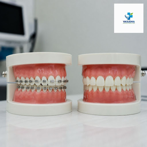 Struggling with an overbite or underbite that affects your smile or chewing? At Vasudha Hospital…