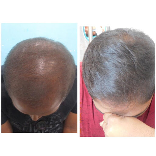 ✨ Hair Fall Treatment in Ganganagar, RT Nagar, Sahakar Nagar, Bangalore ✨ post image