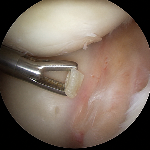 Accidental entry of glass, metal, or bone fragments into a joint can cause severe pain, swelling,… post image