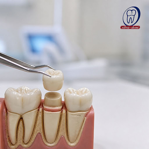 A cracked, worn down or heavily filled tooth doesn’t always need to be removed. Many times, a wel… post image