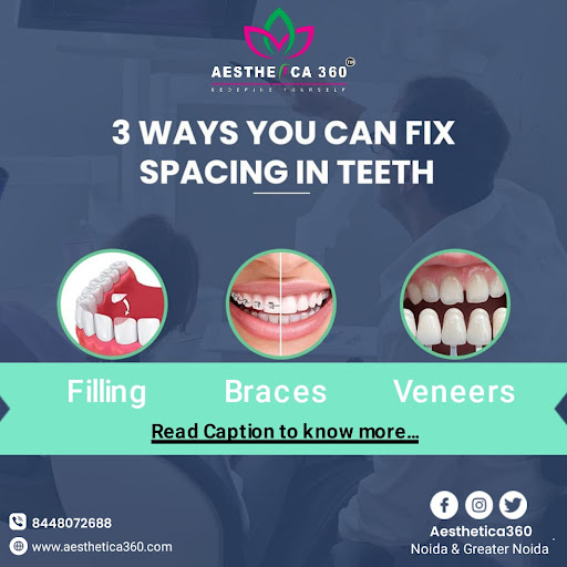 At Aesthetica360 Dental Clinic in Sector 33 Noida, we offer comprehensive teeth spacing treatment…