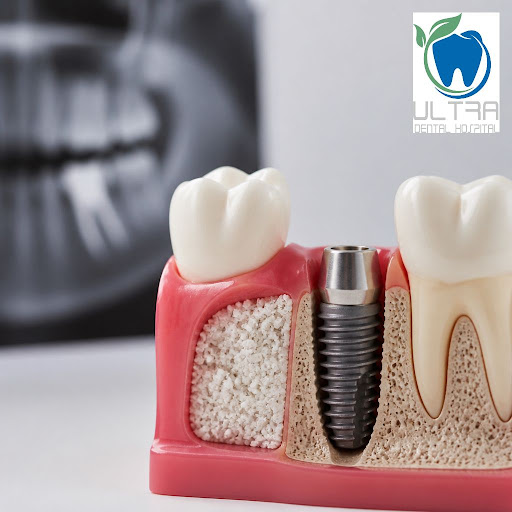 Planning for dental implants but worried about weak or thin jawbone? At Ultra Dental hospital and… post image