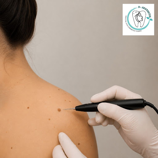 Worried about unwanted moles or skin tags on your face, neck or body? At D-Aesthetix in Trinagar,… post image