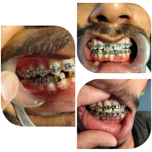 Fixed orthodontic treatment post image