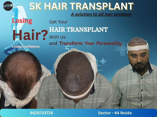 SK Hair Transplant Clinic in Sector 44, Noida NCR, provides innovative baldness treatments and ha… post image