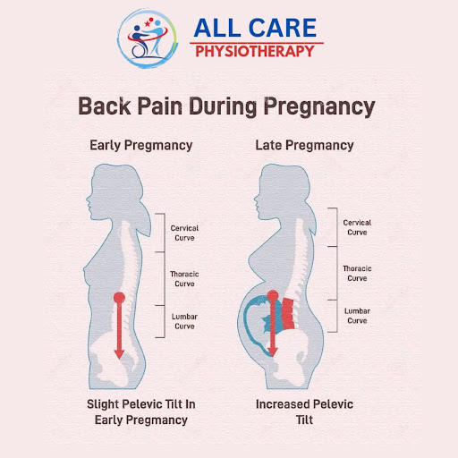 🌸 Back Pain During Pregnancy – Physiotherapy at Home in Delhi 🌸