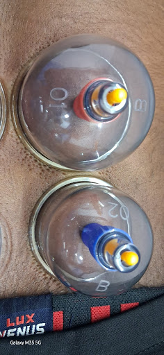 CUPPING THERAPY post image