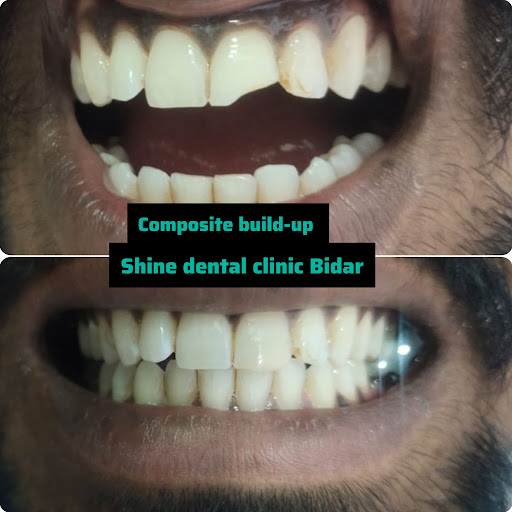 Pt came with complaint of broken anterior tooth and treated with composite build-up.. post image